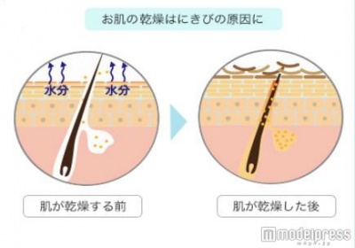 大人ニキビの原因は、肌の乾燥が引き起こす毛穴詰まり