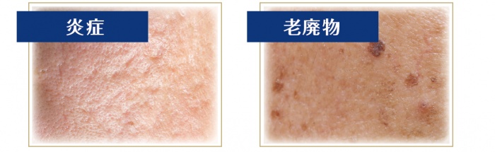 ニキビケア後のトラブル