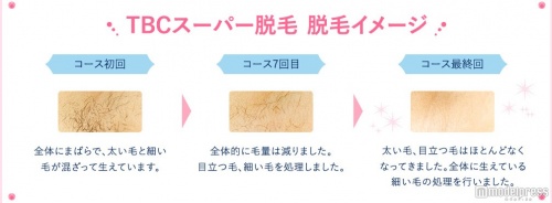 効果によって2種類の脱毛方法が選べる