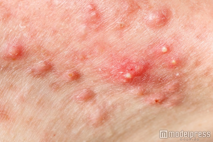 ニキビは跡に残ることもある（Photo by Ocskay Bence／Fotolia）