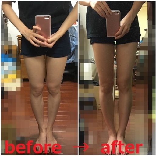 太ももの経過写真