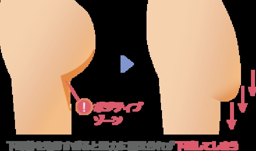 太ももの脂肪吸引でお尻（臀部）が下垂（垂れて）しまう例