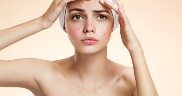 コンシーラーいらずの肌に♡色素沈着系のニキビ跡を消す方法は？