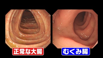 むくみ腸の比較／バラエティ番組『その原因、X（エックス）にあり！』28日放送回より（画像提供：フジテレビ）