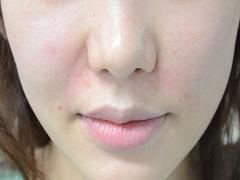 気にするのは美白だけ？あなたの”ほうれい線”笑いシワ超えてますよっ！