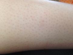 そのブツブツ超目立ってます....毛の処理による"ブツブツ毛穴"を避ける方法