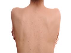 背中ニキビ、どうすればいい？医師が語る原因と改善策