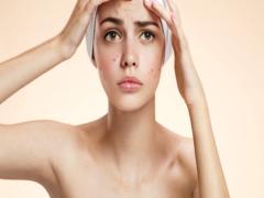 コンシーラーいらずの肌に♡色素沈着系のニキビ跡を消す方法は？