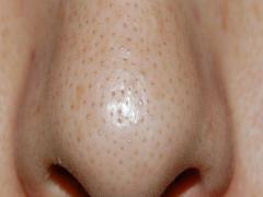 角栓ができる原因は？ 正しい角栓ケア・予防法まとめ