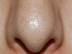 ぶつぶつ気になる鼻の角栓 いちご鼻になる前に適切なケアを