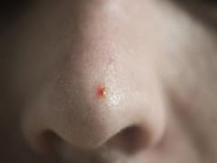 大人ニキビに悩んでいる人必見！「ティーツリー」を使ったケアまとめ