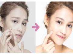 【PMS時期の肌荒れ対処法】焦って過剰ケアするより○○してみる！？