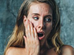 便秘とニキビの関係性って？お通じが良いと肌がキレイになる秘密