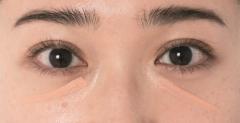 クマはコンシーラーで徹底カバー！青クマ・黒クマ・茶クマ…種類別原因＆おすすめコンシ