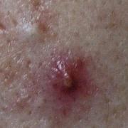 赤ニキビの原因＆対策｜皮膚科のお薬＆治し方、鼻やフェイスラインにできる赤ニキビケア