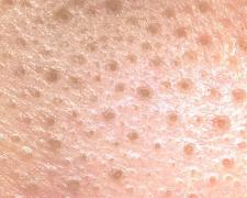 頬や小鼻の角栓ケア｜白い角栓が気になる…とお悩みの方に！頬の角栓ケア＆おすすめパッ