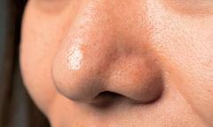 色素沈着の原因と対策のまとめ｜おすすめの治療法、クリーム、化粧水など |