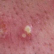 ニキビ跡を消す簡単な方法は？｜コンシーラーで隠して消す方法や治療などのまとめ |