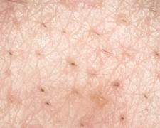 毛穴の黒ずみの原因と対策｜人気の市販洗顔料・クレンジング・パック、皮膚科医おすすめ