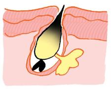 いちご鼻に悩む人へ！毛穴の黒ずみとおさらば！改善法とおすすめアイテムで毛穴レスに