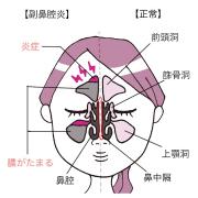 「副鼻腔炎」もしかして鼻の調子が悪いなら…長引くとやっかいな症状について医師が詳し