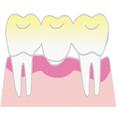 歯がなくなったらどうすればいい？［インプラント・差し歯・ブリッジ］Q&A -